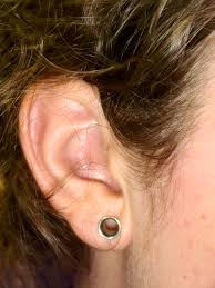 L'otoplastie pour remédier aux oreilles décollées